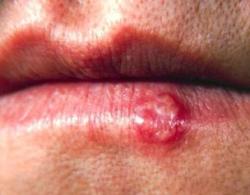 Cold sore remedies