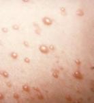 Shingles treatment